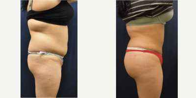 Brazilian Butt Lift before and after photo