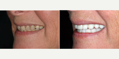 Porcelain Veneers before and after photo
