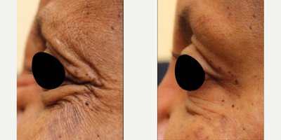 Botox before and after photo