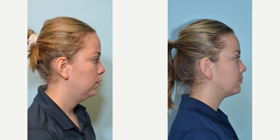 Chin Liposuction before and after photo
