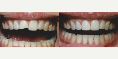 Dental Bonding before and after photo