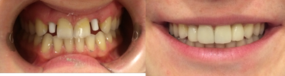 Dental Implants before and after photo