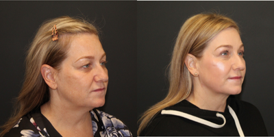 Double Eyelid Surgery before and after photo
