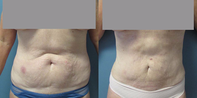 Liposuction before and after photo