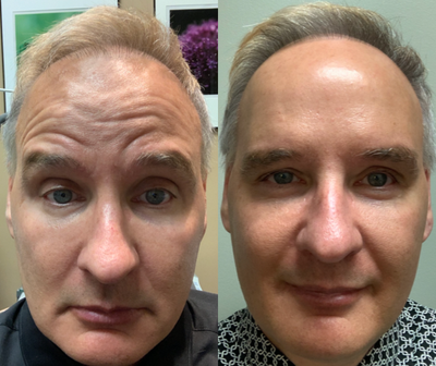 Botox before and after photo