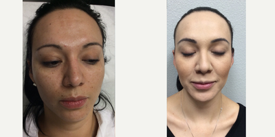 Chemical Peel before and after photo