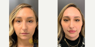 Chin Filler before and after photo
