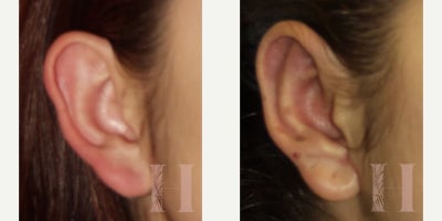 Ear Surgery before and after photo