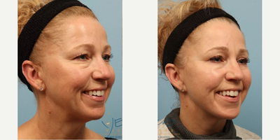 Facelift before and after photo