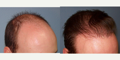 Hair Transplant before and after photo