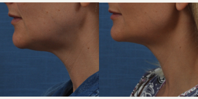 Kybella before and after photo