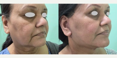 Neck Lift before and after photo