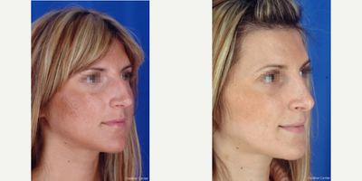Rhinoplasty before and after photo