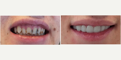 Smile Makeover before and after photo