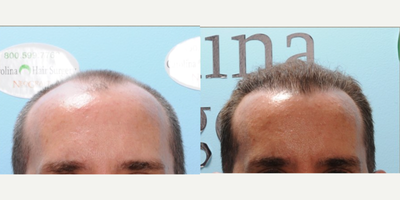 FUE Hair Transplant before and after photo