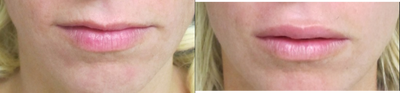 Lip Fillers before and after photo