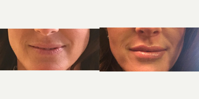 Lip Fillers before and after photo