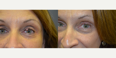 Mole Removal before and after photo
