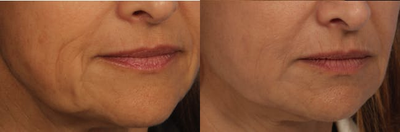 Restylane Defyne before and after photo