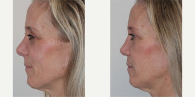 Revision Rhinoplasty before and after photo