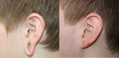 Earlobe Repair before and after photo