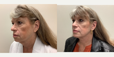 Facelift before and after photo