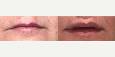 Dermal Fillers before and after photo