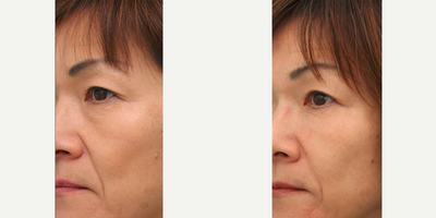 Juvederm before and after photo