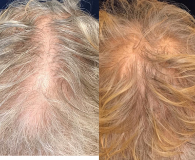 PRP for Hair Loss before and after photo