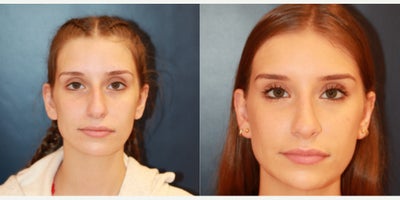Rhinoplasty before and after photo