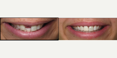 Dental Implants before and after photo