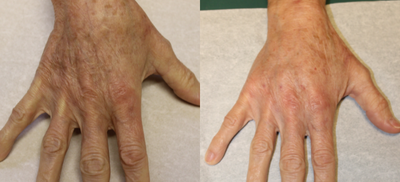 Radiesse before and after photo