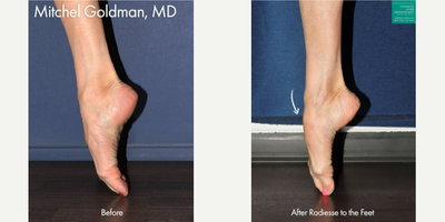 Radiesse before and after photo