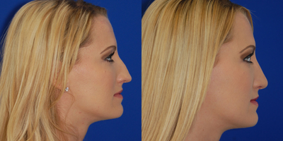 Rhinoplasty before and after photo