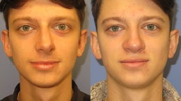 Rhinoplasty before and after photo