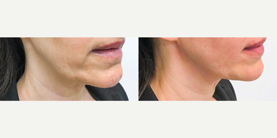 Thread Lift before and after photo