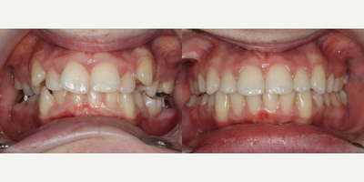 Braces before and after photo