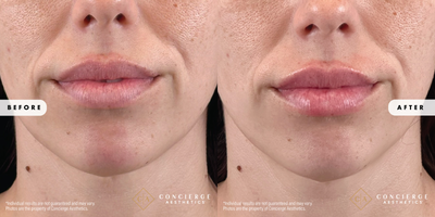 Dermal Fillers before and after photo