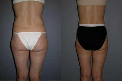 Liposuction before and after photo
