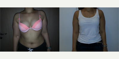 Arm Lift before and after photo