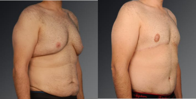 Gynecomastia Surgery before and after photo