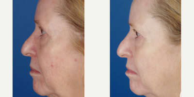 IPL before and after photo