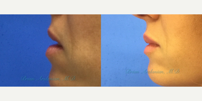 Lip Fillers before and after photo