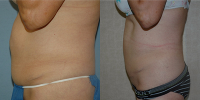 Liposuction before and after photo