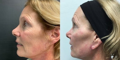 CO2 Laser before and after photo