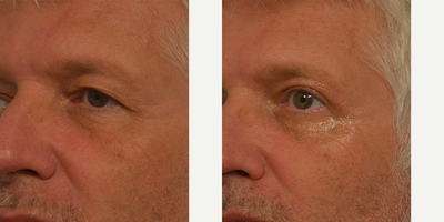 Eyelid Surgery before and after photo