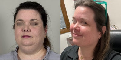 Neck Lift before and after photo
