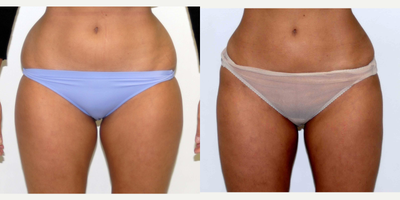 Liposuction before and after photo