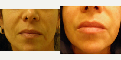 Thread Lift before and after photo