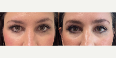 Brow Lift before and after photo